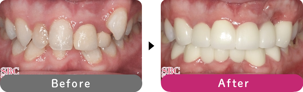 プレミアムダイヤモンドセラミックの症例写真