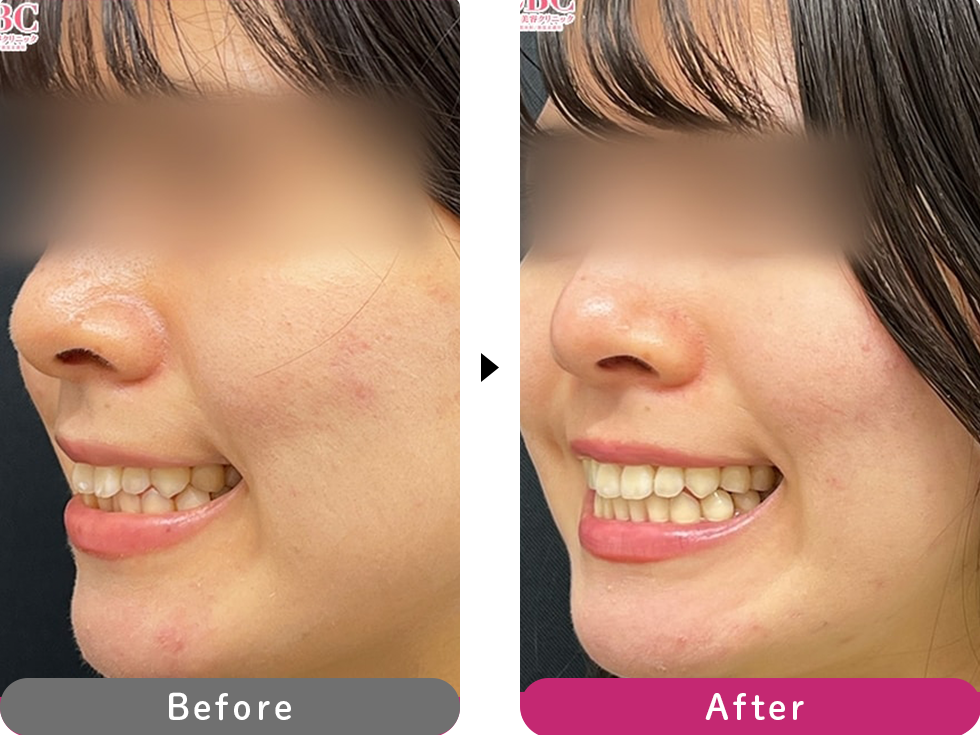 インビザラインモデレートの症例写真