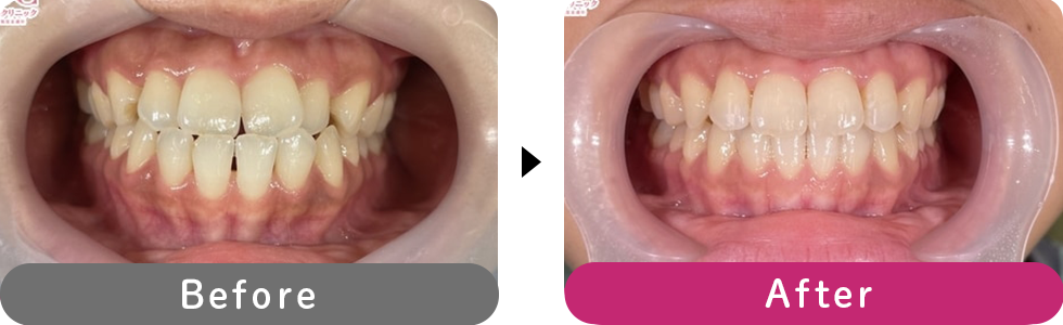 インビザラインモデレートの症例写真