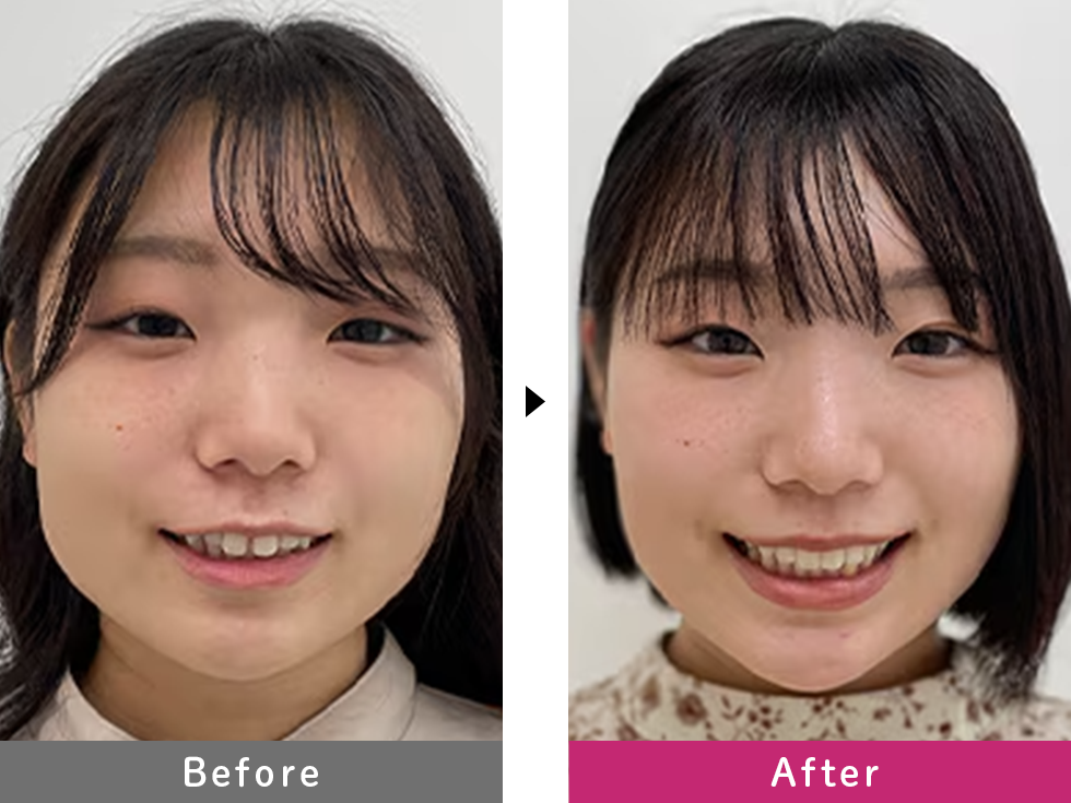 インビザラインGO