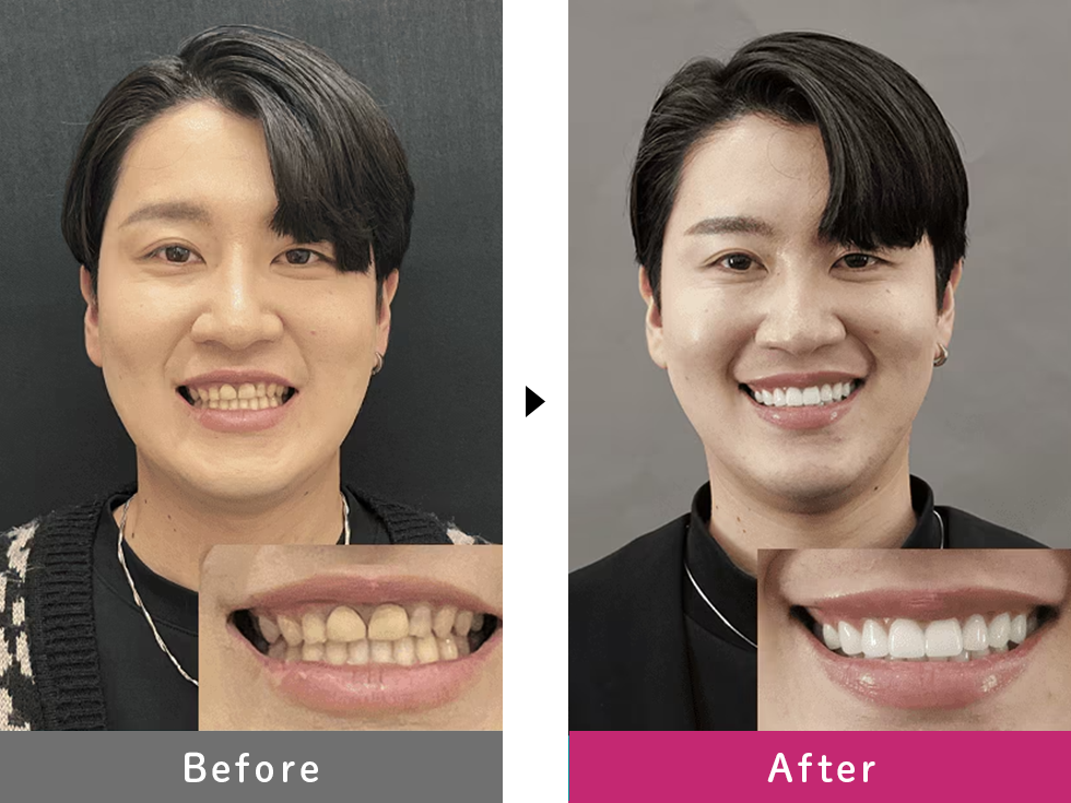 ダイヤモンドオーダーセラミックの症例写真