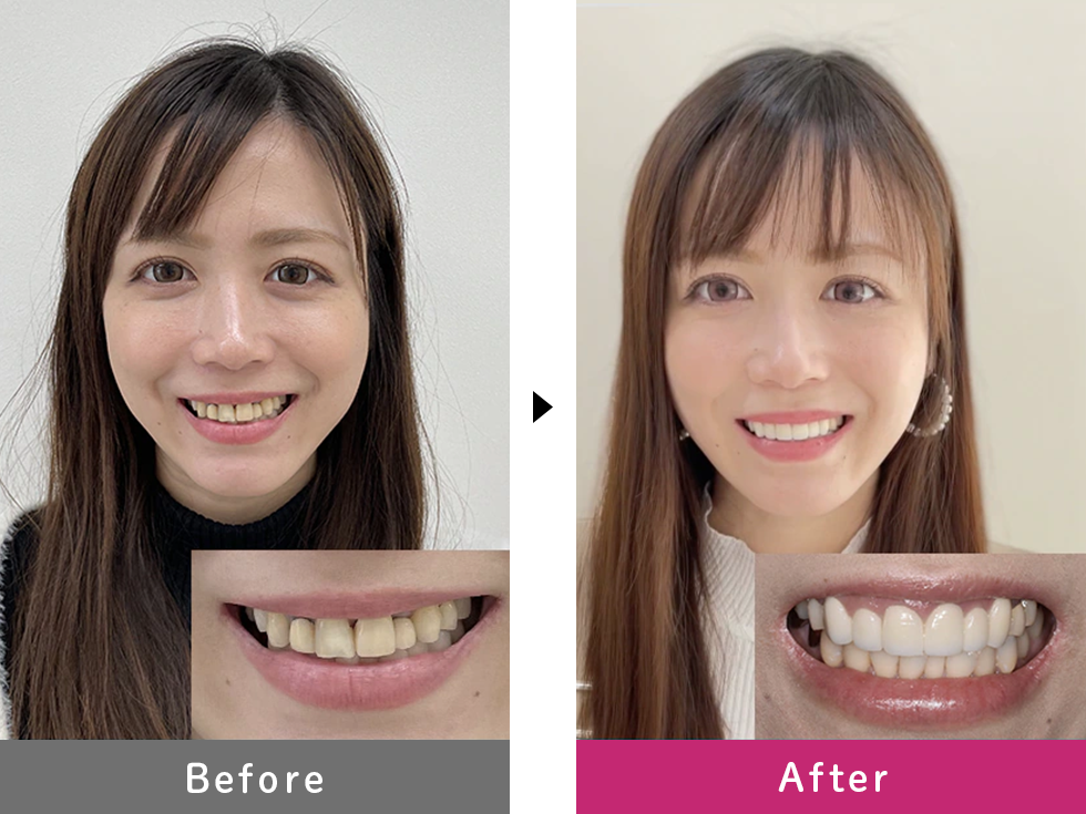 プレミアムダイヤモンドセラミックの症例写真