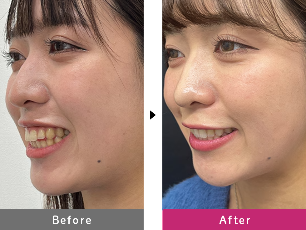 インビザラインモデレート