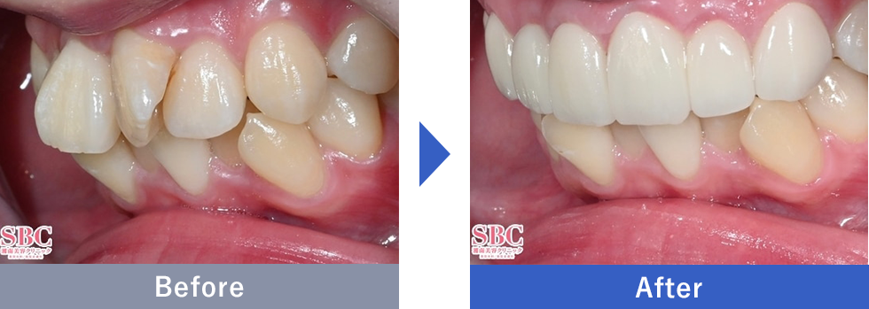 セラミック矯正症例写真