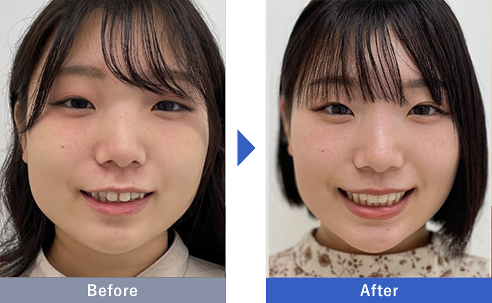 インビザラインGoの症例写真 Before After