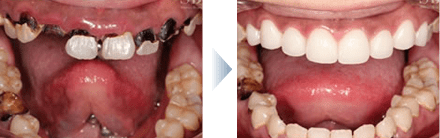 セラミックによる虫歯治療の症例写真