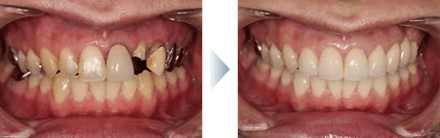 セラミックによる虫歯治療の症例写真