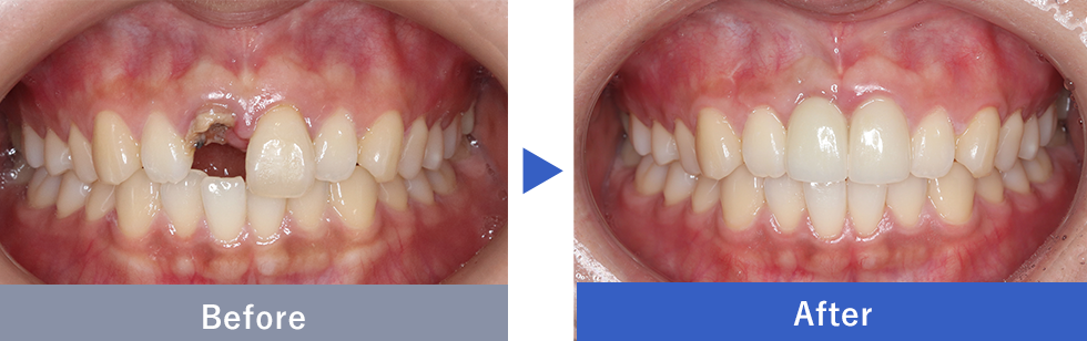インプラントの症例写真 Before After