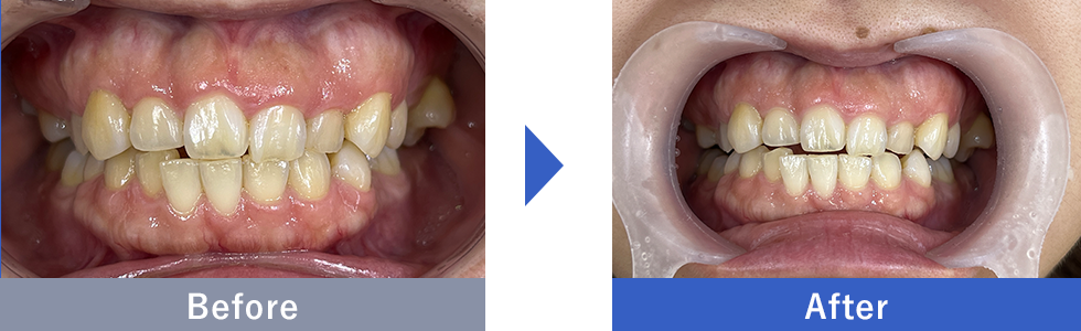 ホワイトニング症例写真