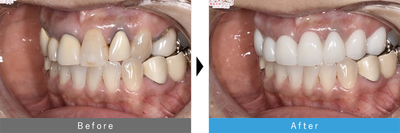 フルジルコニアセラミック 6本セット 症例2 before after