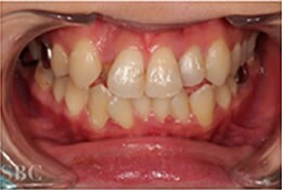 美しい歯並びのメリット 綺麗な歯並びにする方法を歯並びでお悩みの方にご紹介 矯正歯科 歯列矯正 湘南美容歯科