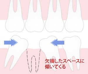 隣接歯の傾斜とは
