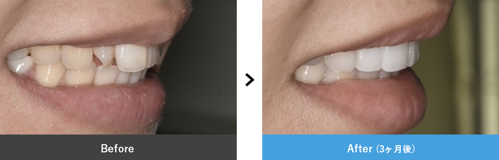 セラミック 症例写真