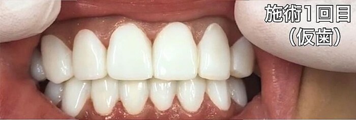 上の歯８本、下の歯８本を改善 施術1回目(仮歯)