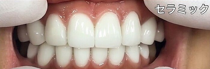 上の歯８本、下の歯８本を改善 セラミック