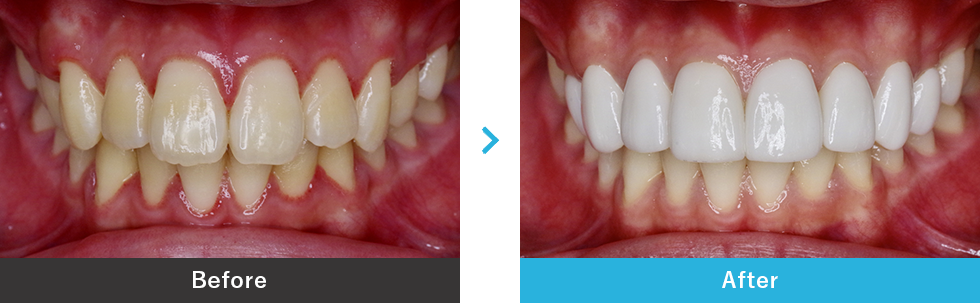 ダイヤモンドベニアの症例写真3 before after