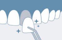 ラミネートべニア施術イメージ