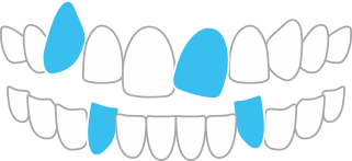 ガタガタした歯並びや八重歯(叢生)
