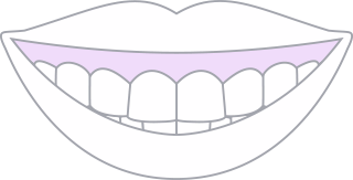 ガミースマイル