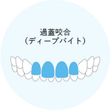 過蓋咬合のイメージイラスト