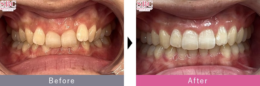 インビザラインモデレートの症例写真