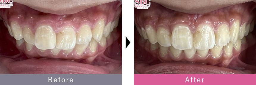 クリアコレクトUNLIMITEDの症例写真