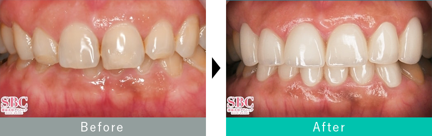 過蓋咬合のセラミック治療症例