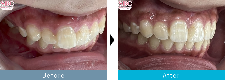 過蓋咬合のマウスピース矯正症例