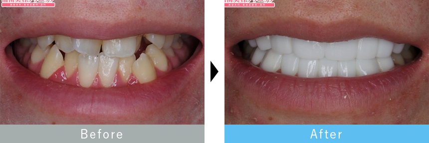 ダイヤモンドクラウン