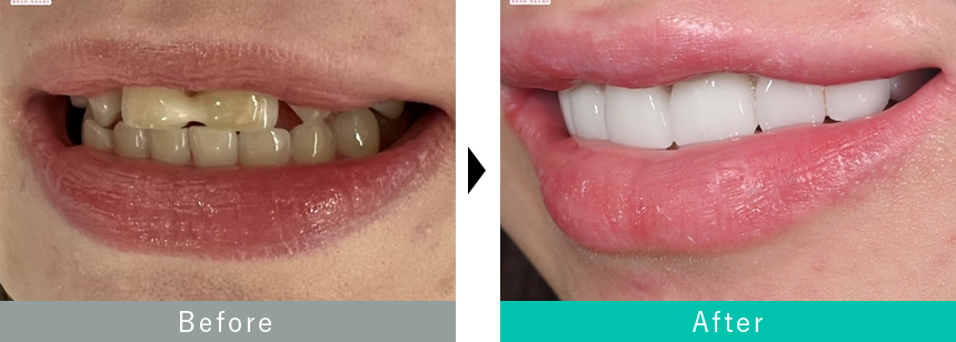 出っ歯のセラミック治療の症例