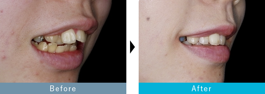 出っ歯のマウスピース矯正の症例