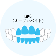 八重歯(叢生・乱ぐい歯)とは?