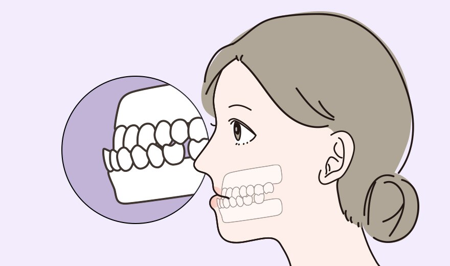 大人の受け口（反対咬合・下顎前突）矯正