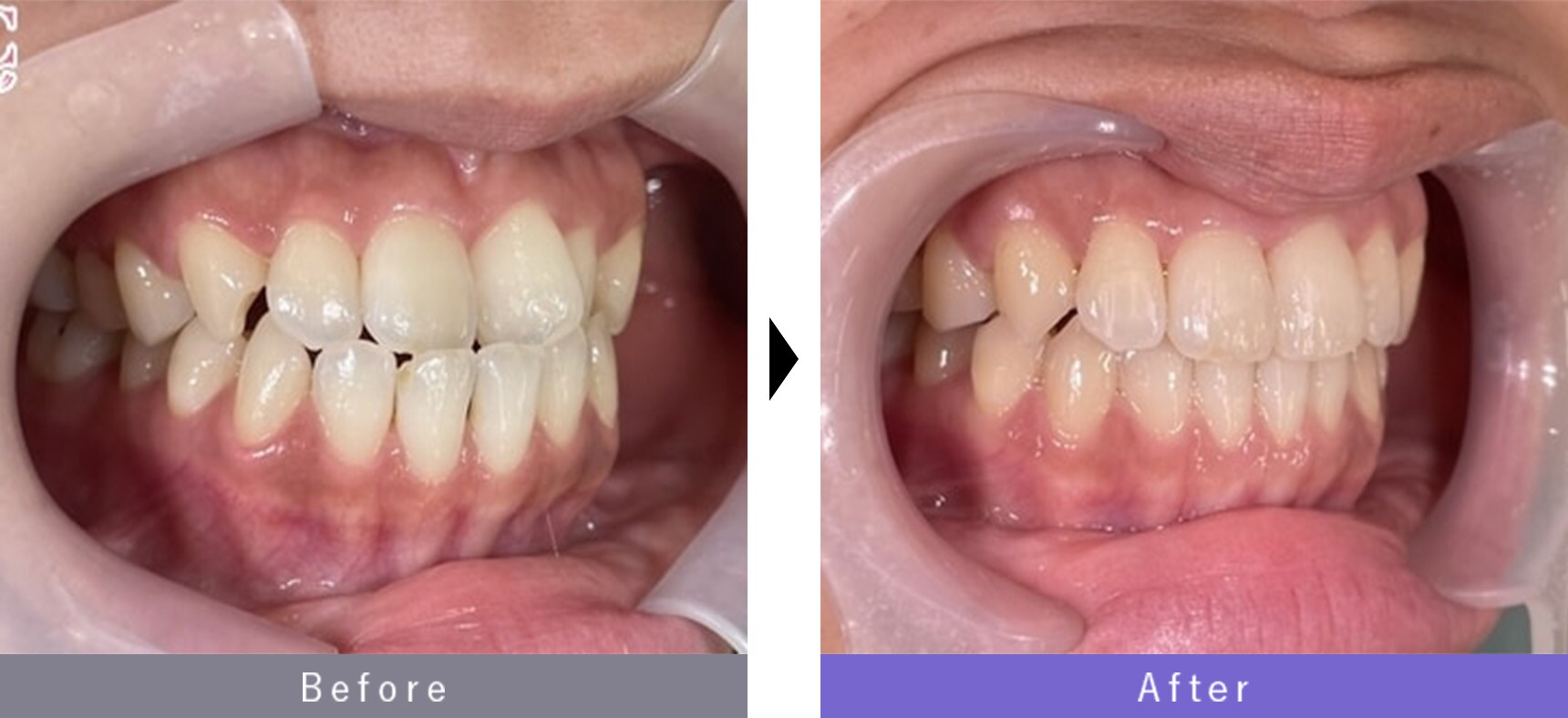 マウスピース矯正の症例写真