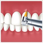 歯のクリーニング施術イメージ