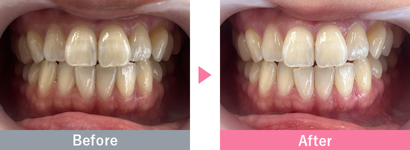 SBCパウダージェットクリーニングの症例写真1