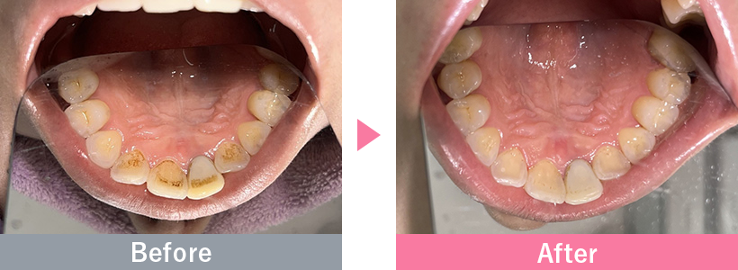 SBCパウダージェットクリーニングの症例写真2