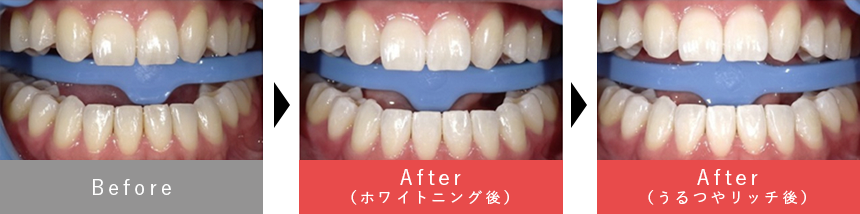スタンダードホワイトニング(オフィスホワイトニング)+うるつやリッチ 症例1