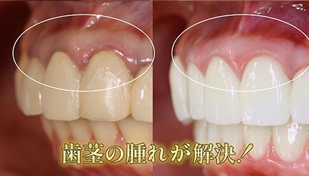 健康的な歯茎に戻すために！