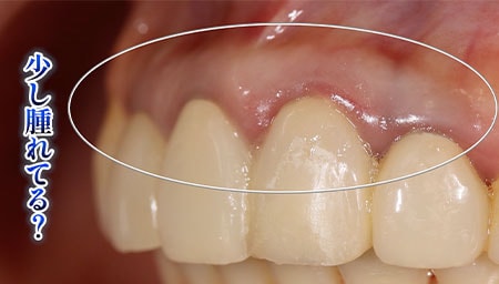 保険の被せ物をした箇所の歯茎が腫れる原因