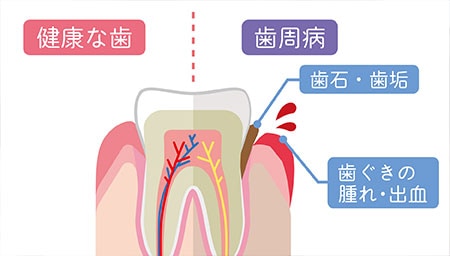 重度の歯周病