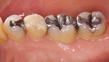 銀歯の治療方法