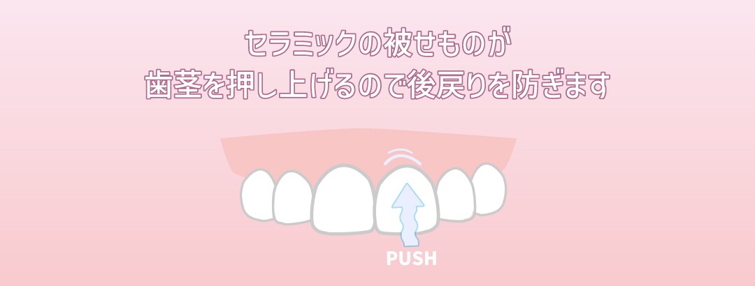 後戻りの防止策①セラミック矯正