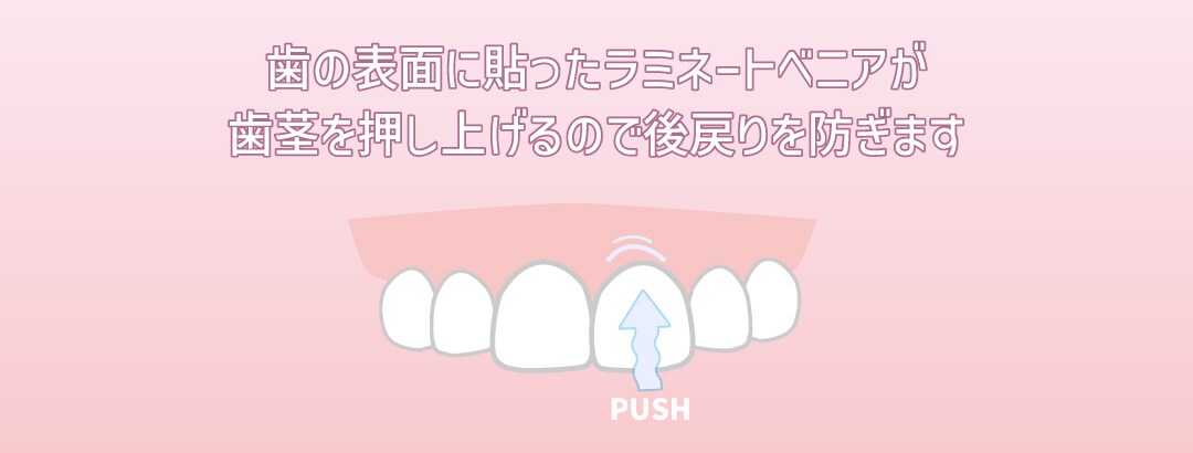 後戻りの防止策②ラミネートベニア