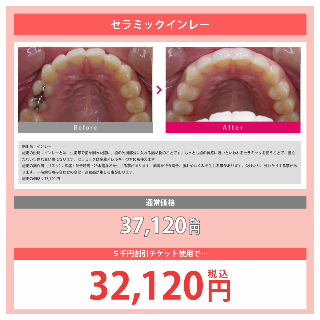 セラミックインレー：通常価格37,120円(税込)が1万円チケット利用で『32,120円(税込)』に！