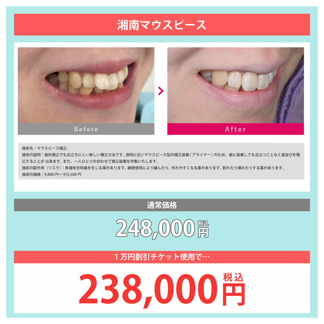 湘南マウスピース：通常価格248,000円(税込)が1万円チケット利用で『238,000円(税込)』に！