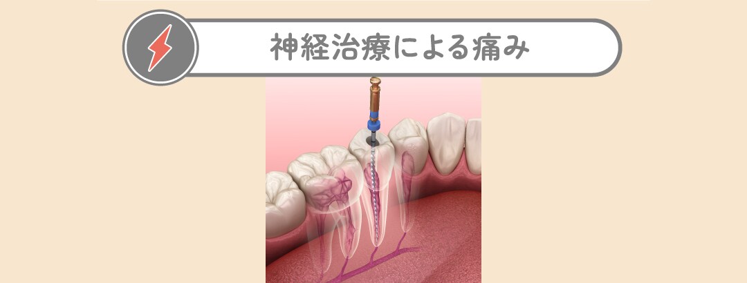 神経治療による痛み