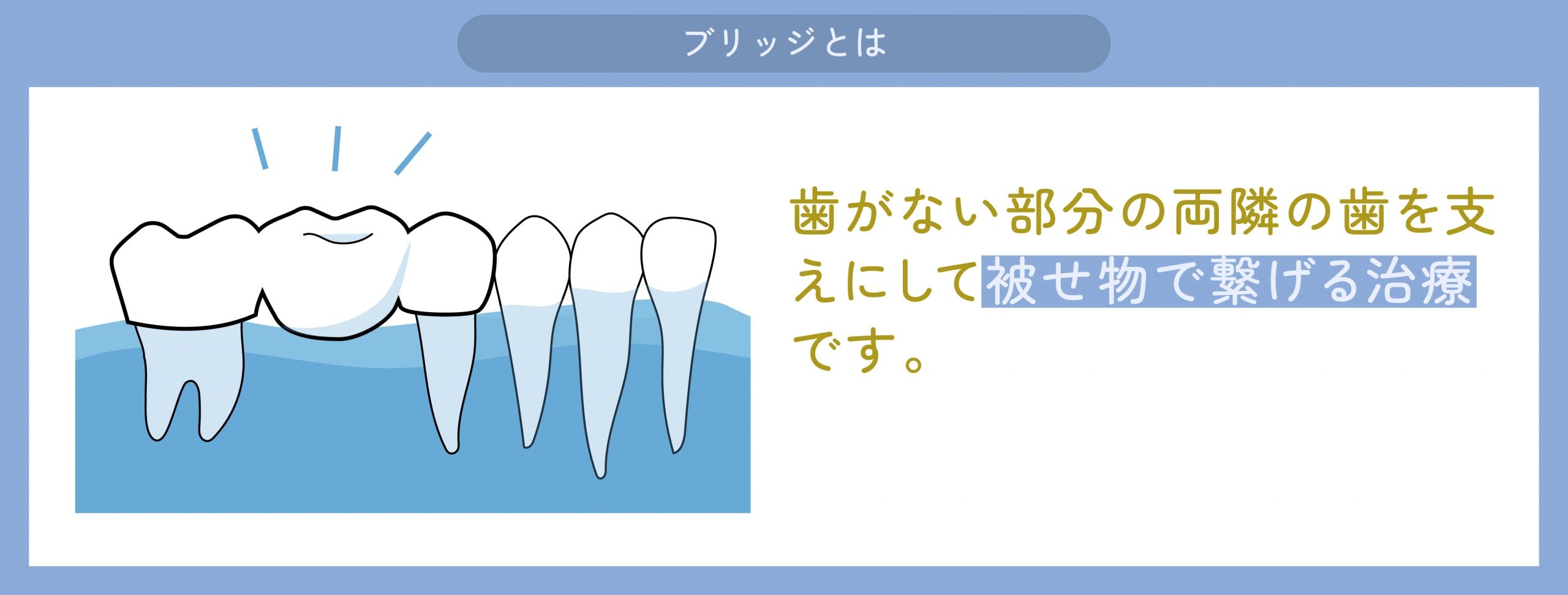 ブリッジとは