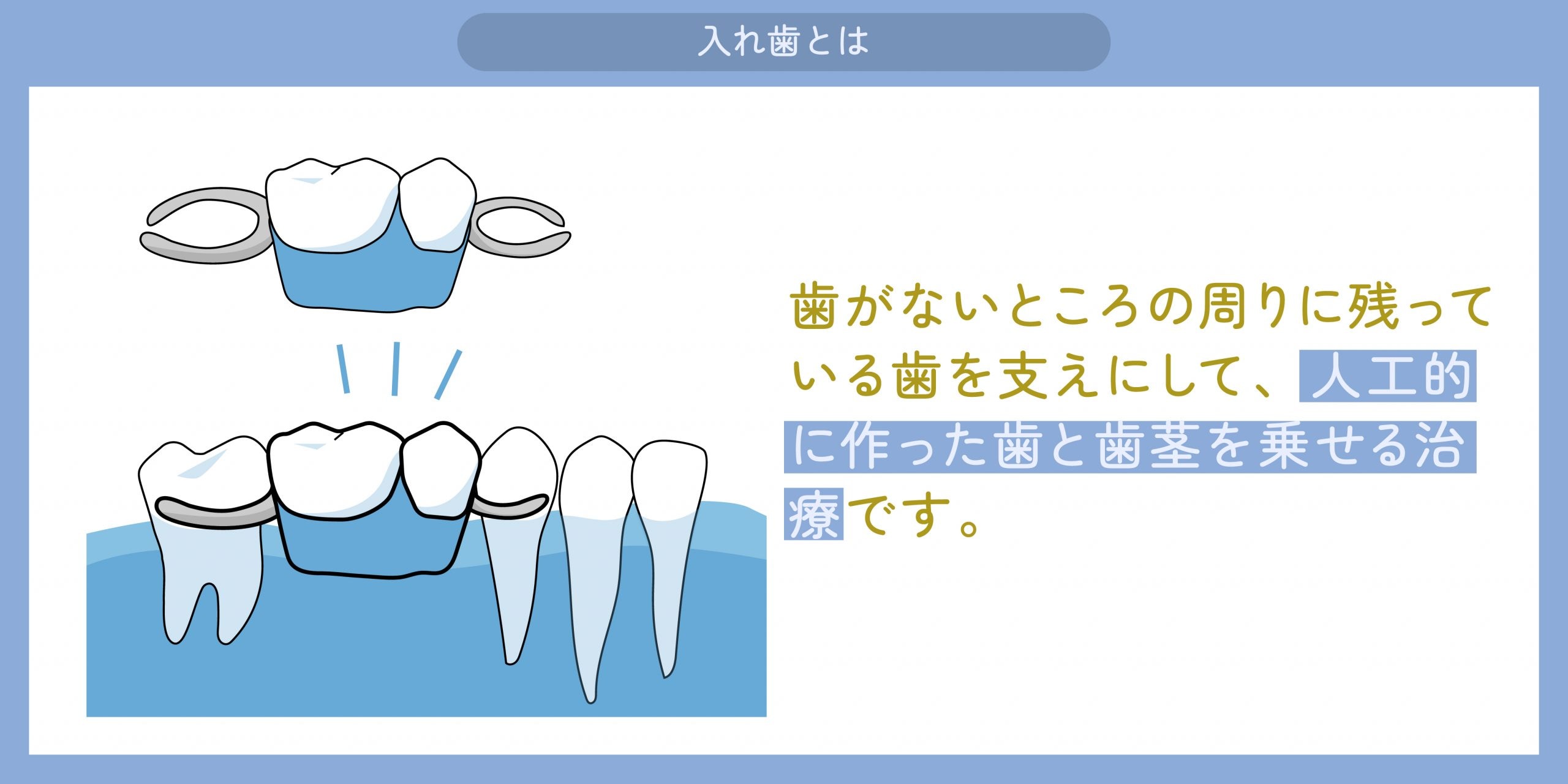 入れ歯とは