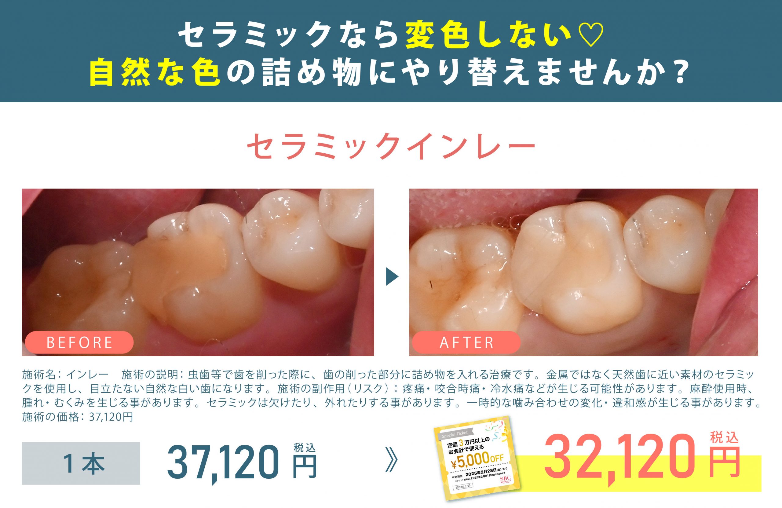 セラミックインレー：通常価格37,120円(税込)が5千円チケット利用で『32,120円(税込)』に！